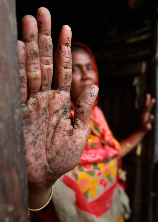 Arsenic toxicity WikEM