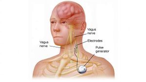 Vagal nerve stimulator complications - WikEM