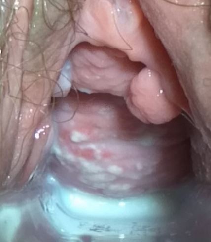 Aggressive undifferentiated carcinoma in the vagina — pic 9