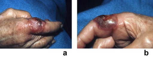 Sweet's syndrome - WikEM