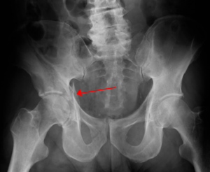 Acetabular fracture (red arrow)