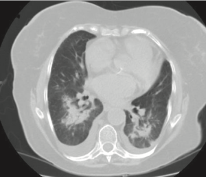 CT Amiodarone Lung Toxicity.png