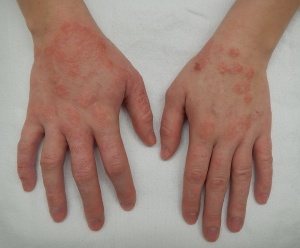 Dermatitis - WikEM