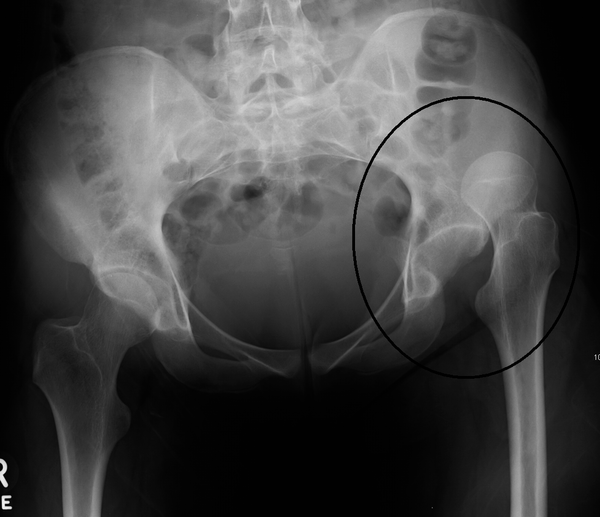 Hip dislocation WikEM