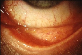 Periorbital swelling - WikEM