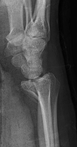 Barton's fracture - WikEM