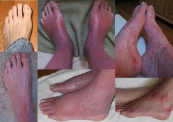 Red (burning) Skin Syndrome - Feet Collage.jpg