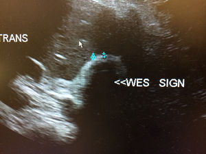 "Wall Echo Shadow" (WES Sign) Non-obstructing gallstones within a contracted gallbladder