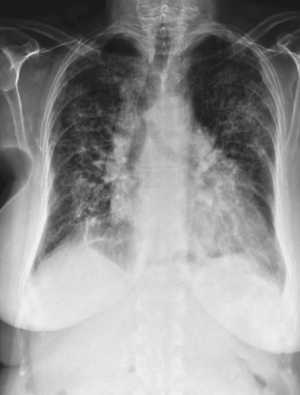 Xray Amiodarone Lung toxicity.png